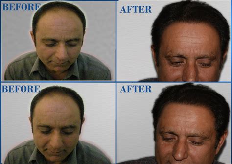 Fue hair transplant cost in Pakistan | Free Consultation | Free Check up