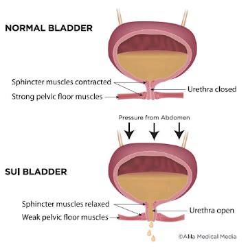 What Is Stress Urinary Incontinence The Pelvic Expert | SexiezPix Web Porn