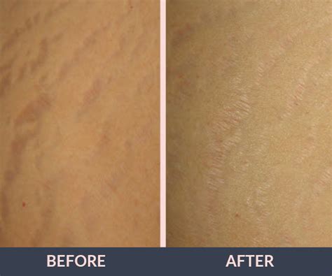 Collection 97 Images Laser Treatments For Stretch Marks Before And