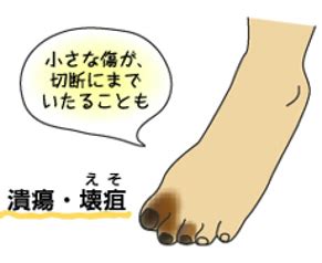 糖尿病とフットケア さくら内科クリニック