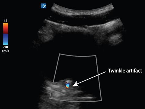 Renal colic - the twinkle artifact - Critical Care Sonography