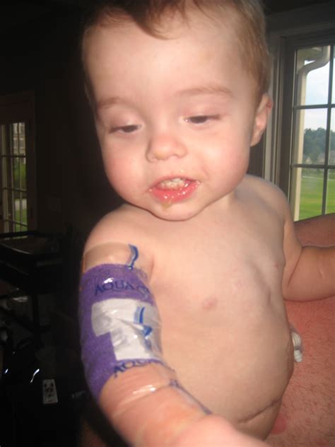 reasoner family update broviacs piccs  ports