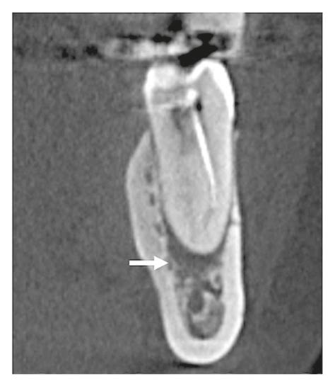 Cbct Slices Of The Mandibular First Molar A Axial Section With The