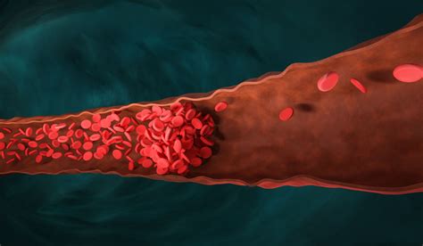 blood clots     signs healthingca