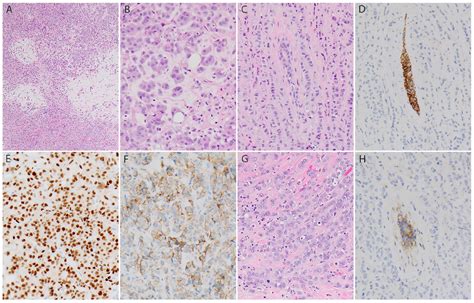 Pleomorphic Invasive Lobular Carcinoma Of The Breast With Extracellular