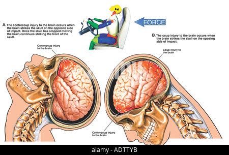 Closed Head Injury Stock Photo Alamy