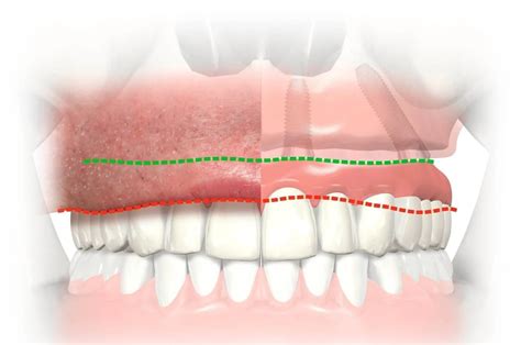 All On 4 Dental Implants Montreal Maxillo 3 Lacs