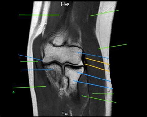 Coronal Mri 4 Diagram Quizlet