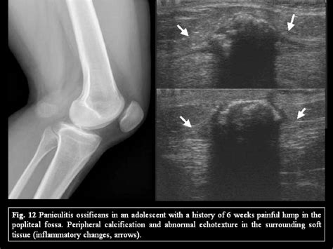 Figure 18 From BENIGN LESIONS OF THE SUBCUTANEOUS SOFT TISSUE WITH