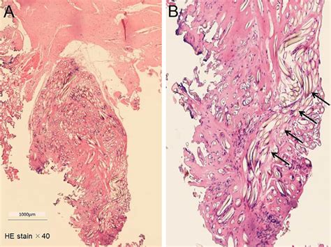 Figure A Histological Findings Of The Spine Like Projection Of The