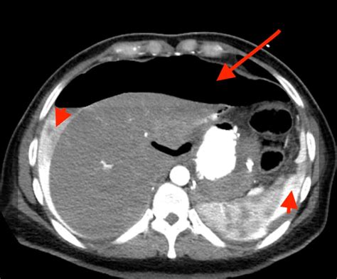 Perforated Marginal Ulcer Post Roux En Y Surgery Without Risk Factors