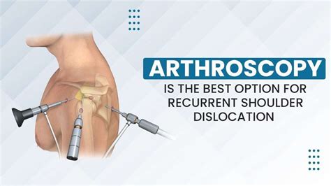 Arthroscopy For Recurrent Shoulder Dislocation