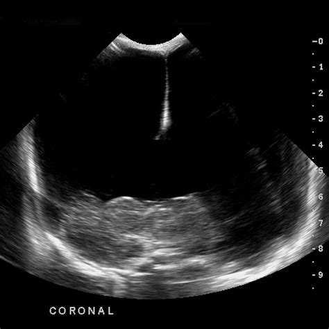 Hydranencephaly Ultrasound