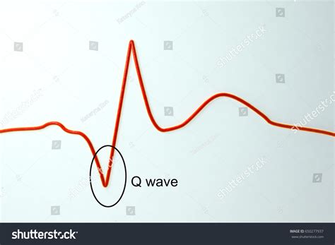 Ecg Myocardial Infarction D Illustration Showing Stock Illustration Hot Sex Picture