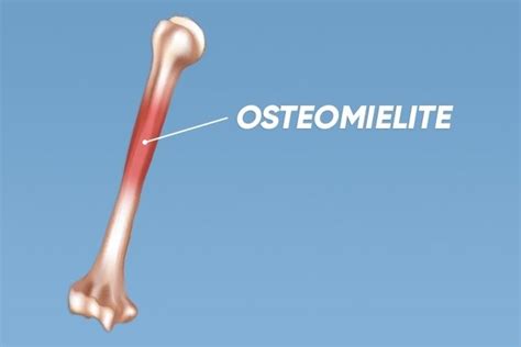 Osteomielite O Que é Sintomas E Tratamento Tua Saúde