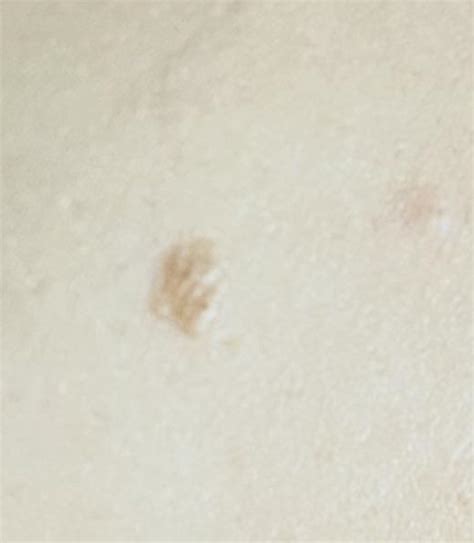 slightly raised mole     completely flat   rubber