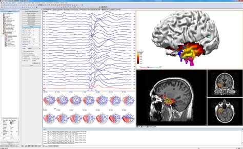 Curry Epilepsy Spike Localization Compumedics Neuroscan