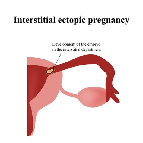 Types Of Ectopic Pregnancy Infographics Vector Illustration On