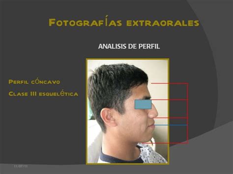 RECONSTRUCCION MANDIBULAR CON INJERTO LIBRE MICROVASCULARIZADO DE