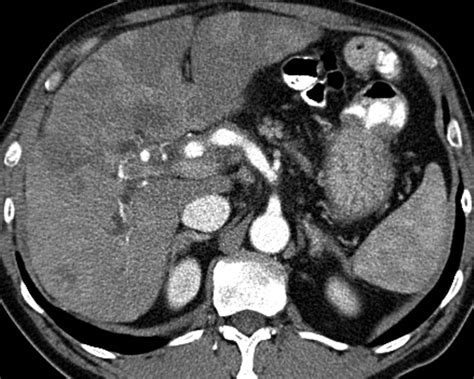 Liver Atlas Case 89 Hepatocellular Carcinoma Hcc Fibrotic Hcc With