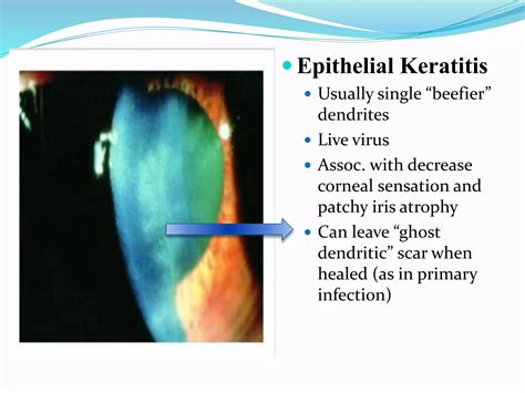 Viral Keratitis Ppt