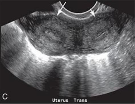 Uterine Anomalies Flashcards Quizlet