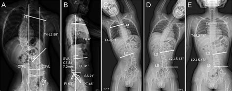 A And B Preoperative Anteroposterior A And Lateral B Standing