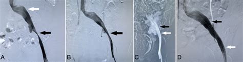 A Venogram Demonstrated Significant Stenosis Of The Left Proximal Download Scientific