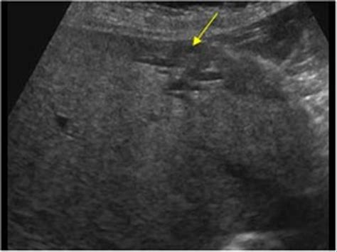 Abdomen And Retroperitoneum 1 1 Liver Case 1 1 16 Miscellaneous