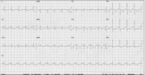 Pulmonary Embolism: Don't Throw Out That EKG! — NUEM Blog