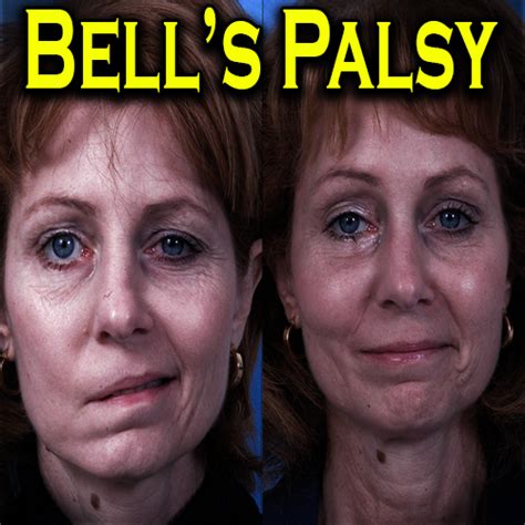 BELL'S PALSY AND HOW I GOT IT - HEALTHY OLD GURU