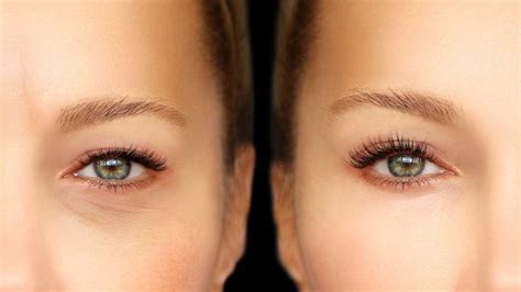 Blepharoplasty Before And After What Are The Effects Of The Procedure • Otco Clinic