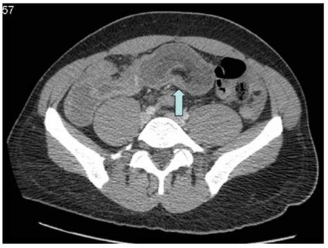 Idiopathic Adult Intussusception Abstract Europe Pmc