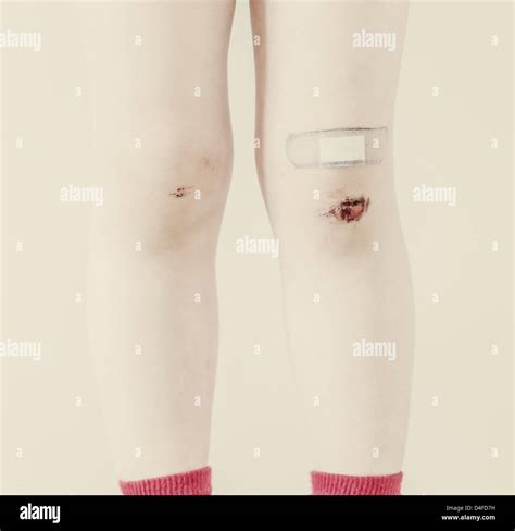 Closeup of the legs of a young child with bruises and bandaid Stock ...