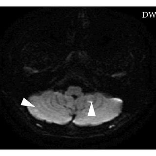 A Diffusion Weighted Mri Sequence Reveals Punctate Areas Of Reduced