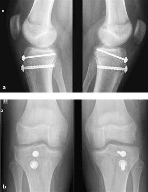 Figure 2 From Simultaneous Bilateral Tibial Tubercle Avulsion Fracture