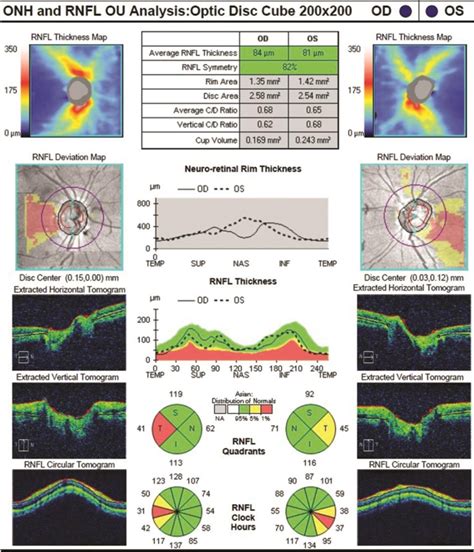 Ad Patient Oct Image Inner And Outer Retinal Layer Irl And Orl [52