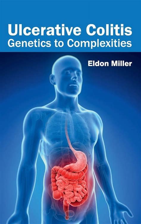 Ulcerative Colitis Genetics To Complexities Hardcover