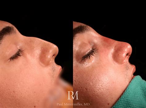 Rhinoplasty Photo Gallery Paul Mittermiller MD