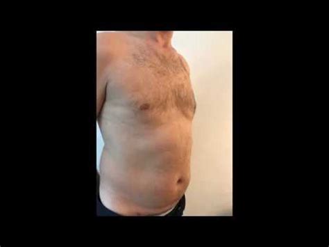 Vaser Liposuction Hi Def Six Pack Before After Ozge Ergun Md