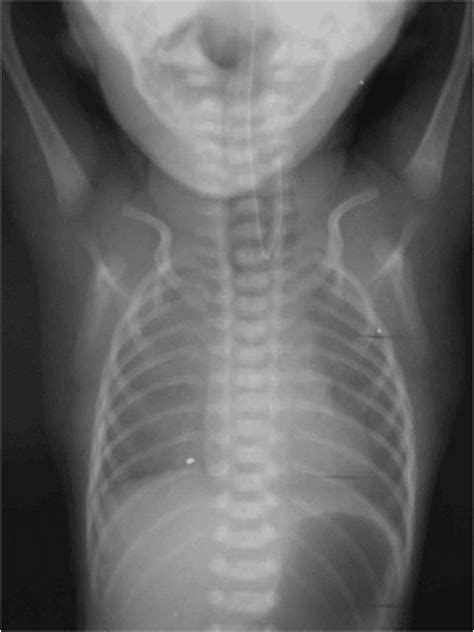 Radiology Image Spotters Esophageal Atresia Tef