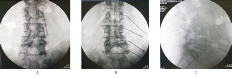 Figure 3 From Radiofrequency Denervation Of Lumbar Facet Joints In The