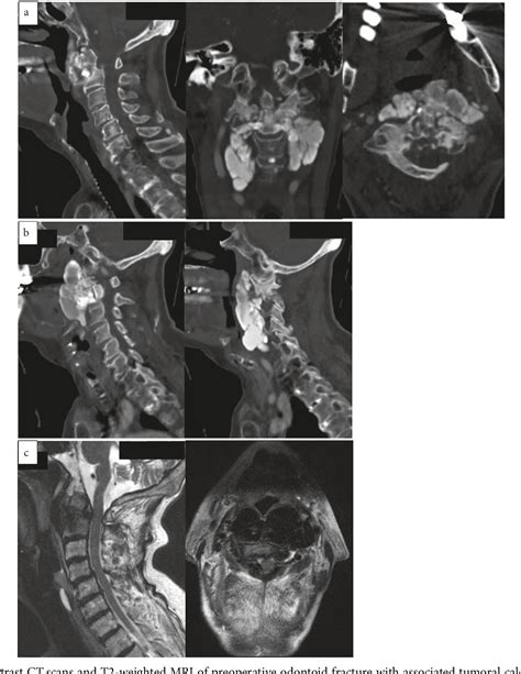 Figure From Tumoral Calcinosis Of The Cervical Spine Associated With