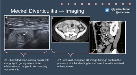 Meckel Diverticulum Xray