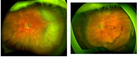 Sclerouveitis With Exudative Retinal Detachment Associated With Chronic