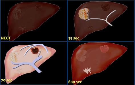 The Radiology Assistant Ct Contrast Injection And Protocols