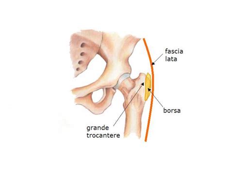 Trocanterite che cosè sintomi e terapia retehphitalia it blog di