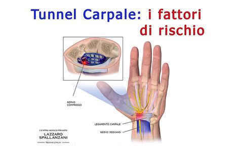 Tunnel Carpale I Soggetti A Rischio E Le Cause Della Sindrome CMLS