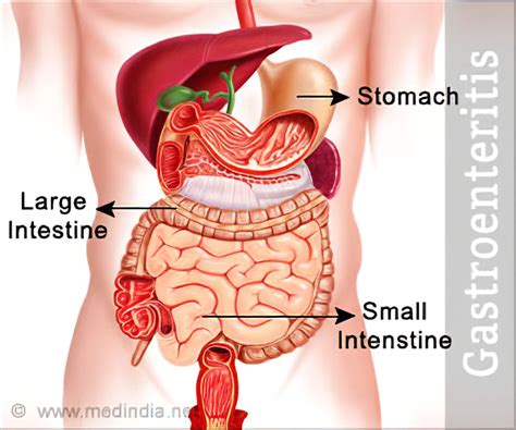 Anunciante Hospitalidad aguacero stomach infection tablet Hacia atrás ...