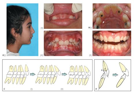 Class II Division 1 Malocclusion